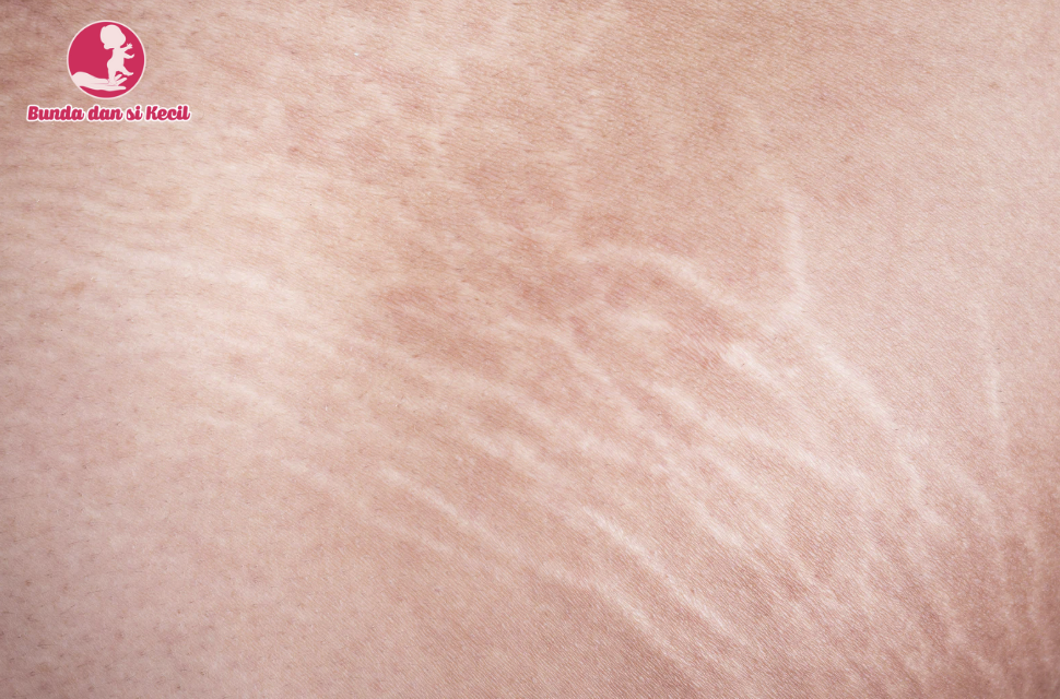 7 Cara Alami Menyamarkan Stretch Mark Setelah Melahirkan